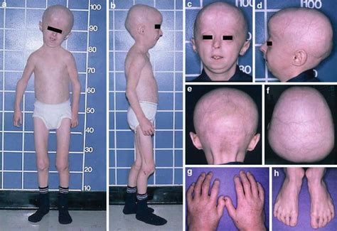 Progeria Springerlink
