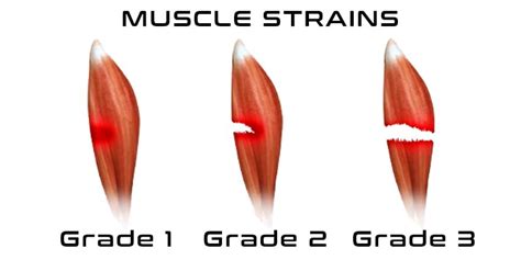 Muscle Strain Grading Traditional Grading Versus Modern Approach