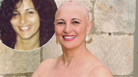 Alopecia Sufferer Juliana Might Have Lost Her Hair But She Found True