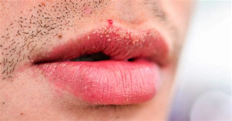White Spots Under Skin In Corner Of Lips Lips Makeupview