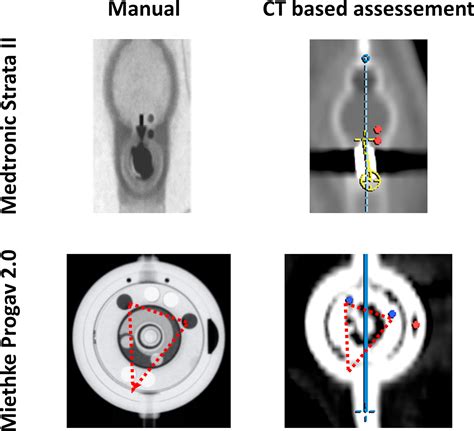 Computed Tomography Based Assessment Of Programmable Shunt Valve