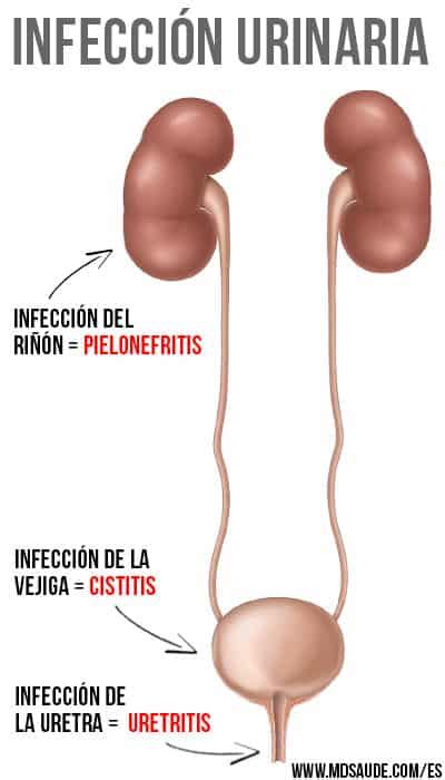 Infección urinaria tipología causas y tratamientos Part