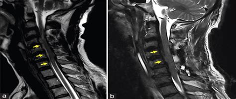 Spontaneous Cervical Spinal Epidural Haematoma In A Recent D