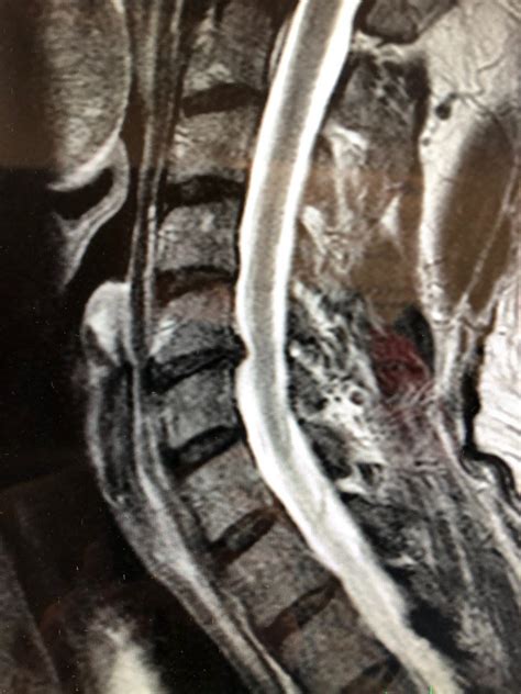 Cervical Disc Herniation North Shore Spinal And Sports Rehabilitation