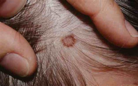 Pin On Skin Cancer Basic Information