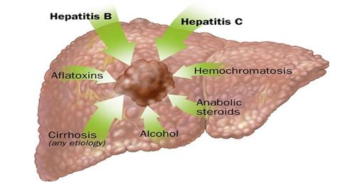 ¿puedes Sentir El Cáncer Al Crecer