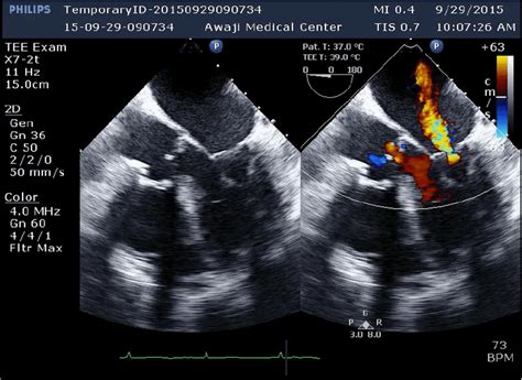 Preoperative Transesophageal Echocardiography Images Showing Mitral