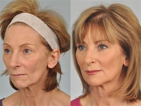 Neck Lift Procedure Steps A Neck Lift Procedure Includes The Following