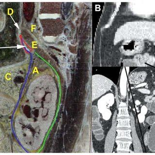 Greater omentum lesser omentum this disambiguation page lists articles associated with the same title. A: LES; B: lesser omentum; C: left gastric artery; D ...