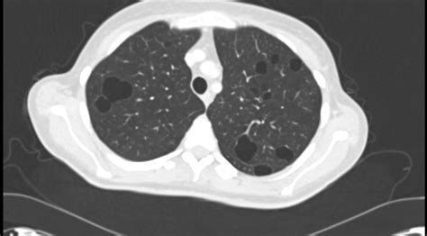 Unusual Cystic Lung Metastasis Bmj Case Reports