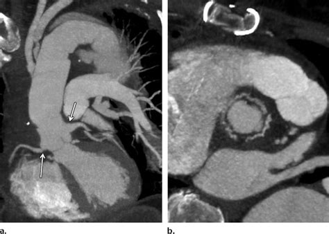 Figure 3 From Pre And Postoperative Imaging Of The Aortic Root