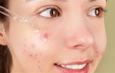 My Acne Wont Go Away A Dermatologist Explains The Reason
