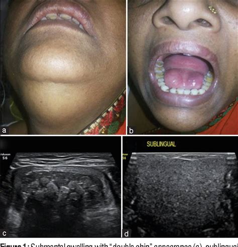 Figure 1 From Two Concurrent Large Epidermoid Cysts In Sublingual And