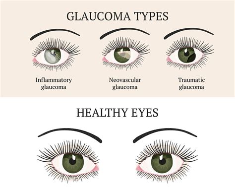 Glaucoma Chart Accent Eye Care