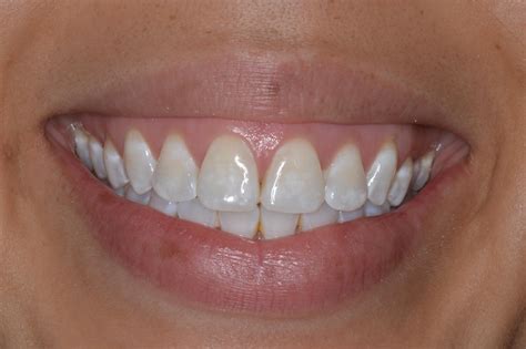 White Spots On Your Teeth An Explanation And Treatment