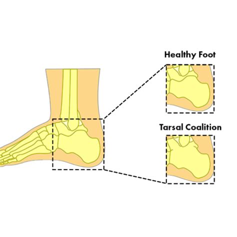 Tarsal Coalition Causes Symptoms And Treatment Dr Foot Podiatry