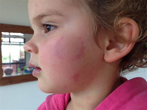 Shocking Pictures Emerge Of Two Year Old Girl Bruised Scratched And