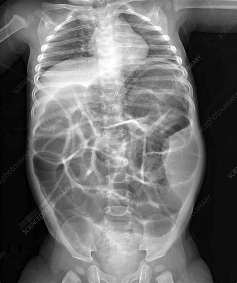 Intussusception Of The Intestines X Ray Stock Image F0342058