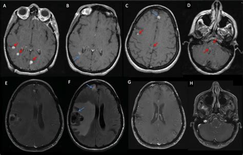 Cureus Stereotactic Radiosurgery For Multiple Brain Metastases Two