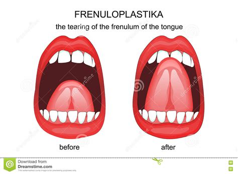 Frenuloplastika The Tearing Of The Frenulum Of The Tongue Stock Vector Illustration Of