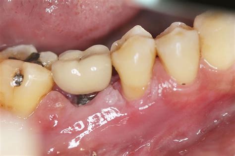White Gums Around Teeth Is It A Sign Of Infection