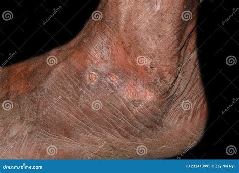 Dry And Scaly Skin In Foot Dermatitis Foot Stock Photo Cartoondealer