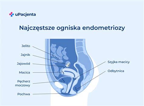 Endometrioza Objawy I Leczenie