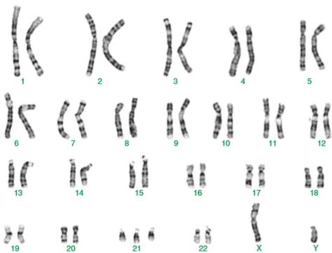 Translocation Down Syndrome Karyotype