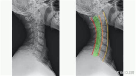 Cervical Spine Lateral View