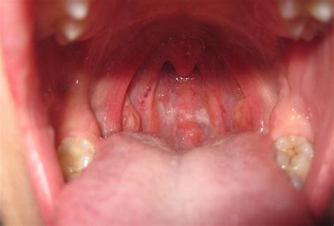 Pain In One Side Of Throat Causes Symptoms And Treatment