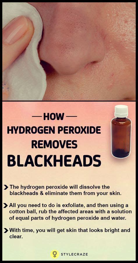 How To Use Hydrogen Peroxide To Remove Blackheads With Images