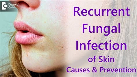 Why Do I Get Recurrent Fungal Skin Infections Dr Amee Daxini Youtube