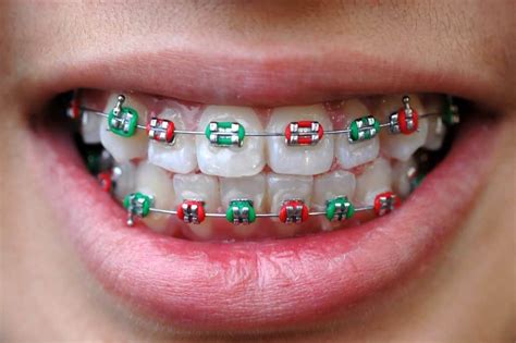 Colored Braces Beach Braces Orthodontic Specialists