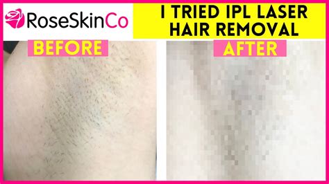 Ipl Laser Hair Removal Week Update Before After Youtube