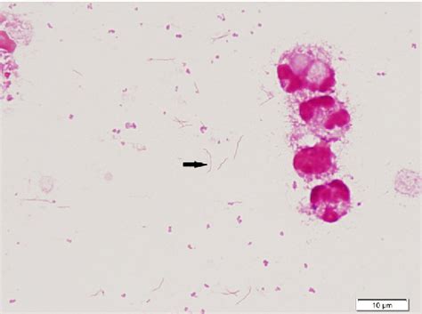 Figure 1 From Preterm Labor And Neonatal Sepsis Caused By Intrauterine