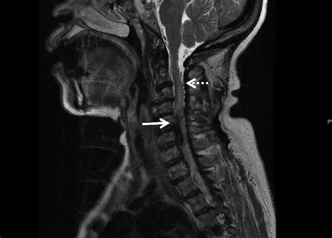 Cureus Arteriovenous Malformation Of The Cervical Spine Presenting As