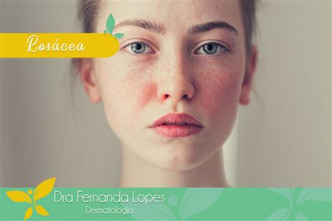 Dra Fernanda Lopes Dermatologia Blog Rosácea