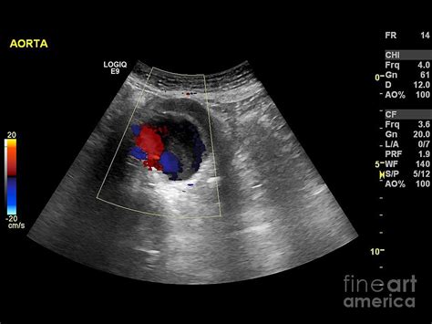 Abdominal Aortic Aneurysm Ultrasound Photograph By Science Photo