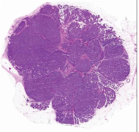 Invasive Lobular Carcinoma Image