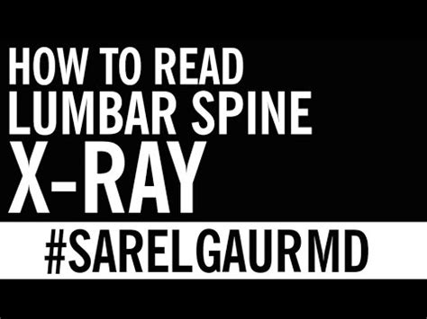 Bit early for age but not serious. How to Read Lumbar Spine X-Ray | Search Pattern - YouTube