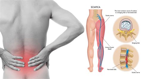 If you have low back pain, hip pain or various other tightness and stress in your body, stretching and/or strengthening the psoas can potentially completely fix the psoas is part of the group of muscles known as hip flexors, and it is the largest and strongest muscle in that group. 8 Sciatica Stretches to Help Prevent and Relieve Hip and ...
