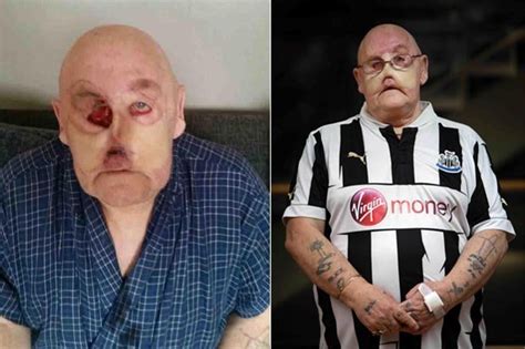 Rare Blood Vessel Cancer Leaves Man With Huge Hole In Face