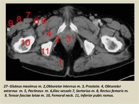 Presentation1pptx Ct Normal Anatomy Of The Abdomen And Pelvis