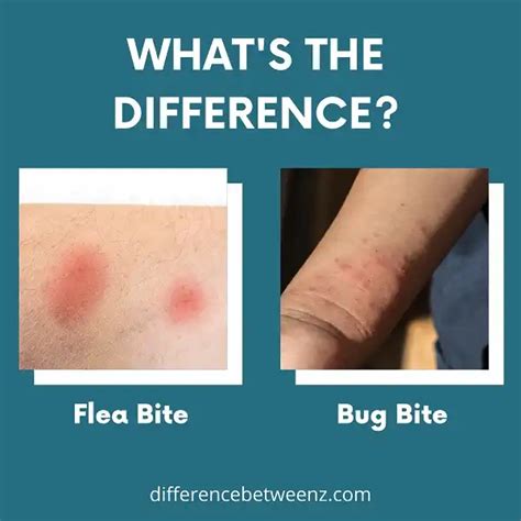 Difference Between Flea And Bed Bug Bites Difference Betweenz