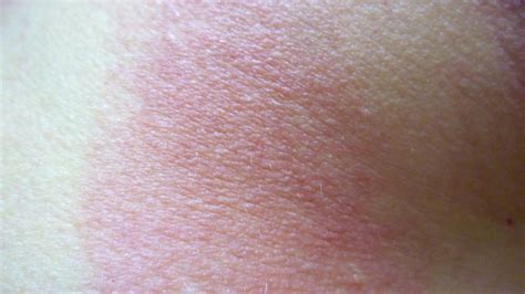 Polymorphous Light Eruptionpmle Pictures And Sun Allergy Rash Images