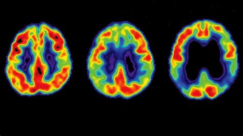 Alzheimers Progression Mild Moderate And Severe Stages Everyday