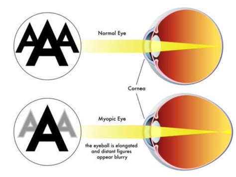 Myopia Causes Symptoms Diagnosis Types And Treatment