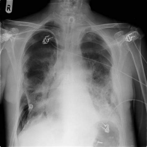 Chest X Ray Showing Right Pneumothorax With An Intercostal Drain In