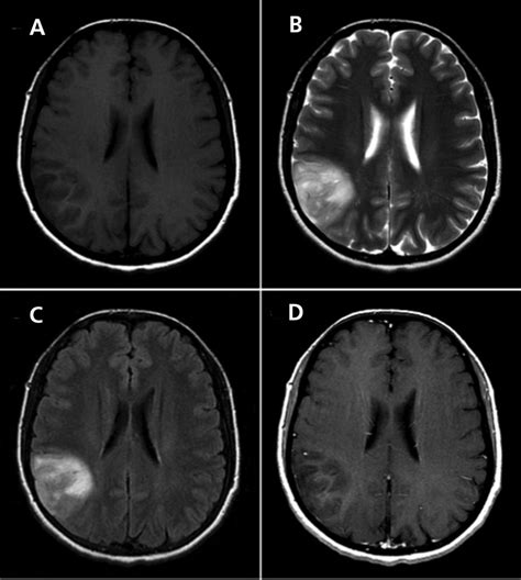 Role Of Mri In Primary Brain Tumor Evaluation In Journal Of The