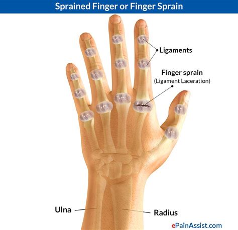 Middle Finger Ligament Injury